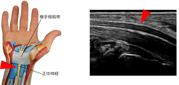 正常の正中神経