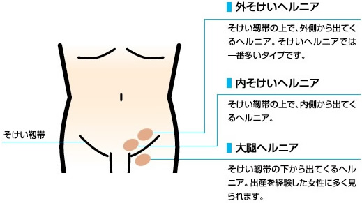 鼠径 ヘルニア 原因